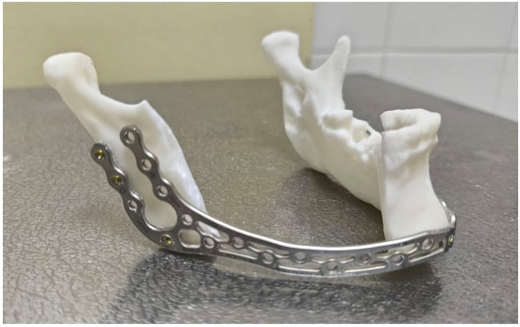 Mandibular bridging plate contoured on a three-dimensional printed mandible model