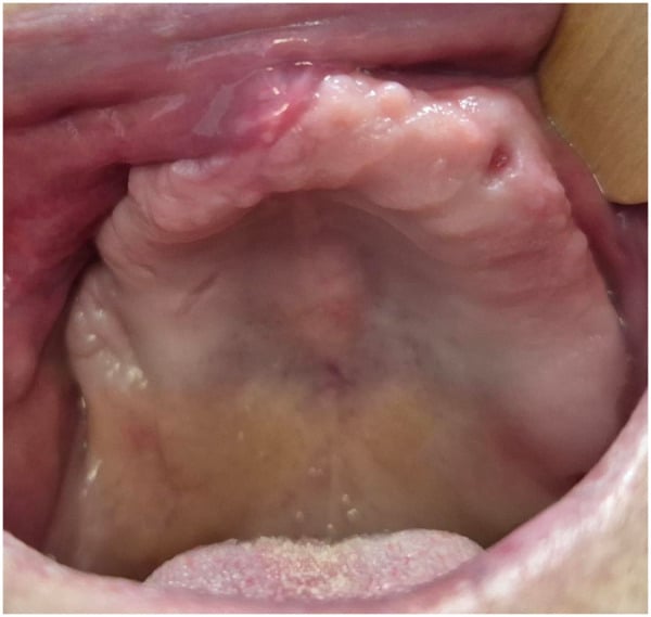 Intraoral view showing healed mucosa nine months after surgical treatment of MRONJ