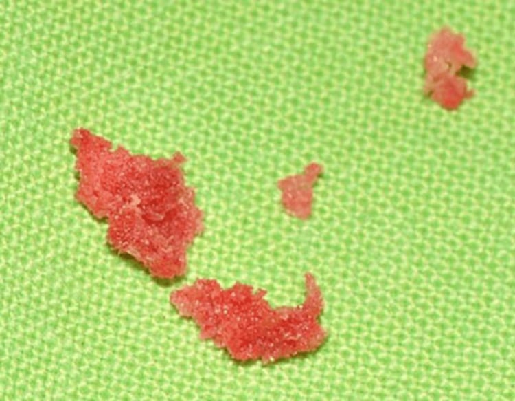 Gross specimen of sponge-like necrotic bony fragments obtained at incisional biopsy