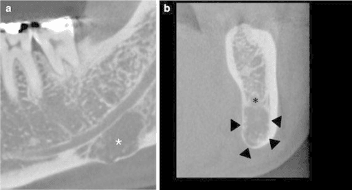 Two-panel CT of the mandible: sagittal view with asterisk marking abnormal bone, and axial view showing a sequestrum outlined by arrowheads