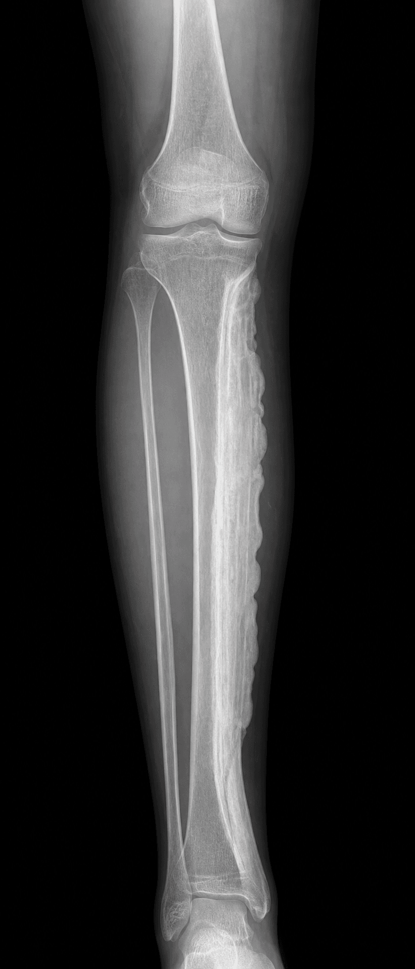 melorheostosis dripping candle wax radiograph