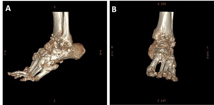 Three-dimensional CT reconstructions showing extensive melorheostotic ankle spurs