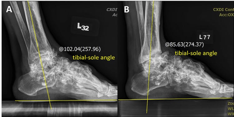 Preoperative and postoperative weight-bearing ankle radiographs with tibial-sole angle measurements