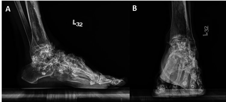 Weight-bearing lateral and anteroposterior ankle radiographs showing flowing hyperostosis and rigid equinus deformity