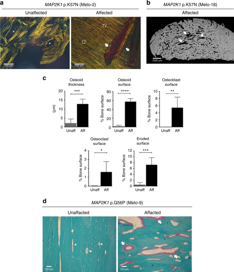 Polarised histology, micro-CT, quantitative plots and stained sections comparing affected and unaffected melorheostotic bone