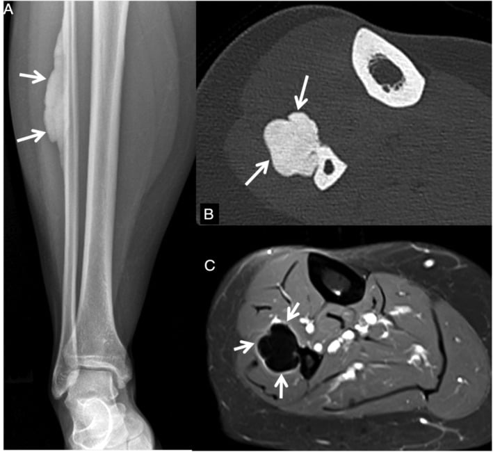 Fibular radiograph, axial CT and axial MRI showing a lobulated parosteal melorheostotic lesion