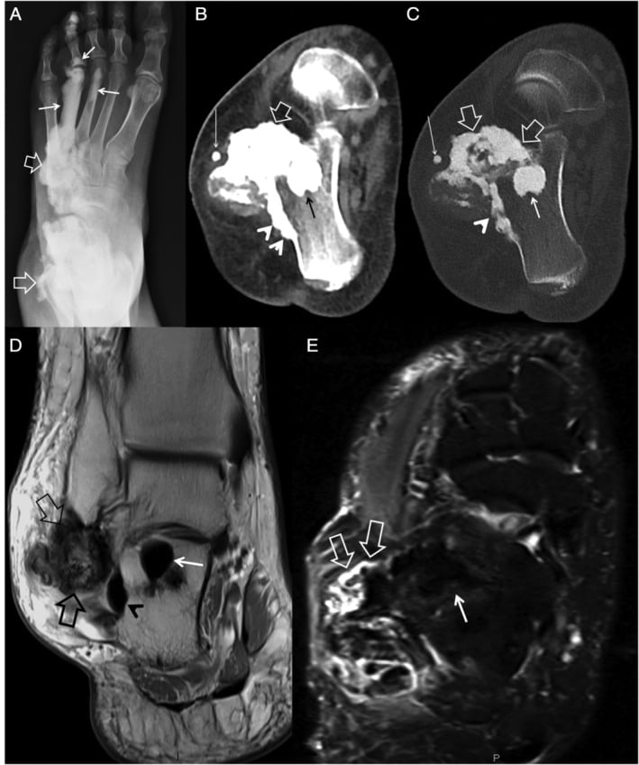 Foot radiograph, CT and MRI showing endosteal, parosteal and periarticular melorheostosis