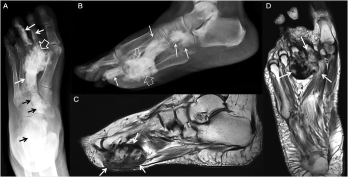 Foot radiographs and MRI showing endosteal, parosteal and soft-tissue melorheostotic lesions