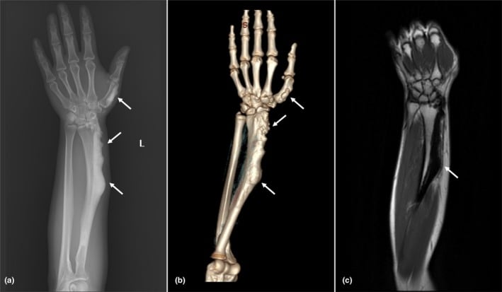 Forearm radiograph, three-dimensional CT and MRI showing eccentric radial and first-metacarpal hyperostosis