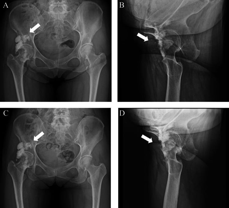 Immediate and final follow-up hip radiographs after excision of a symptomatic melorheostotic mass