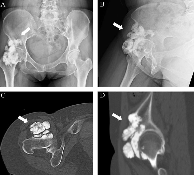 Hip radiographs and CT showing an anterior periarticular melorheostotic mass