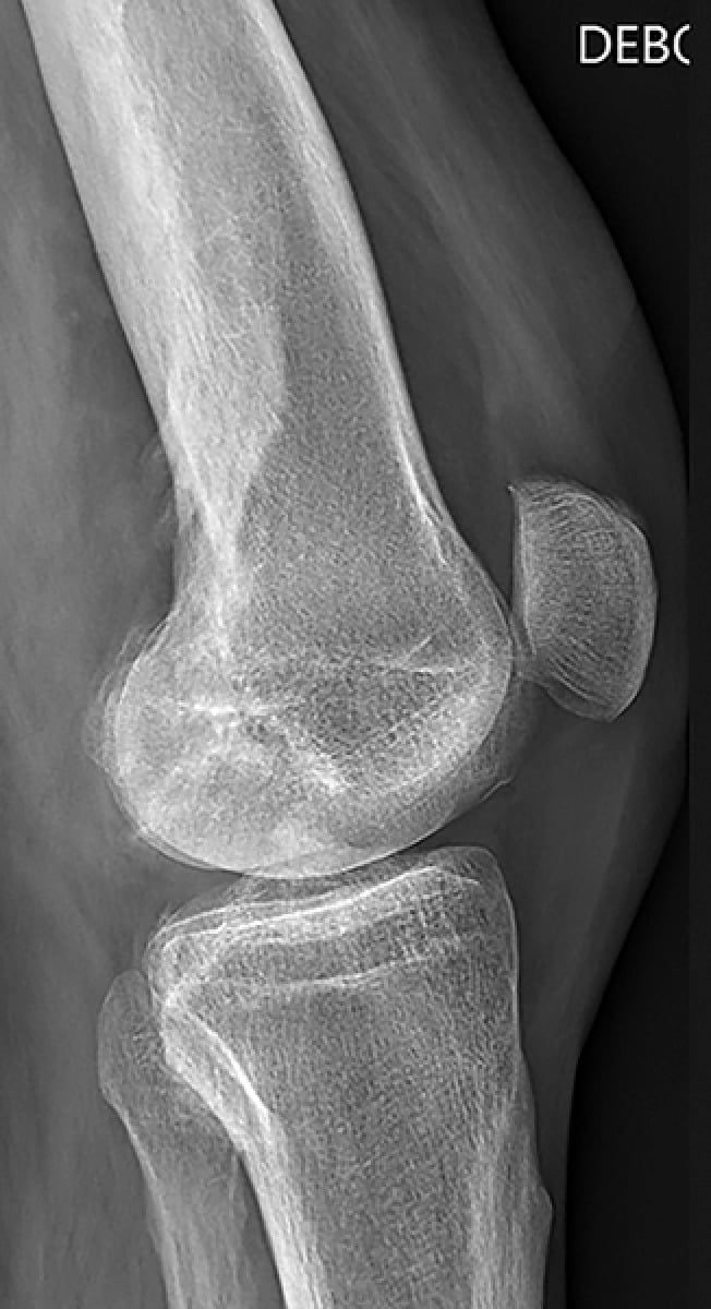 Lateral knee radiograph showing eccentric flowing cortical hyperostosis of the distal femur