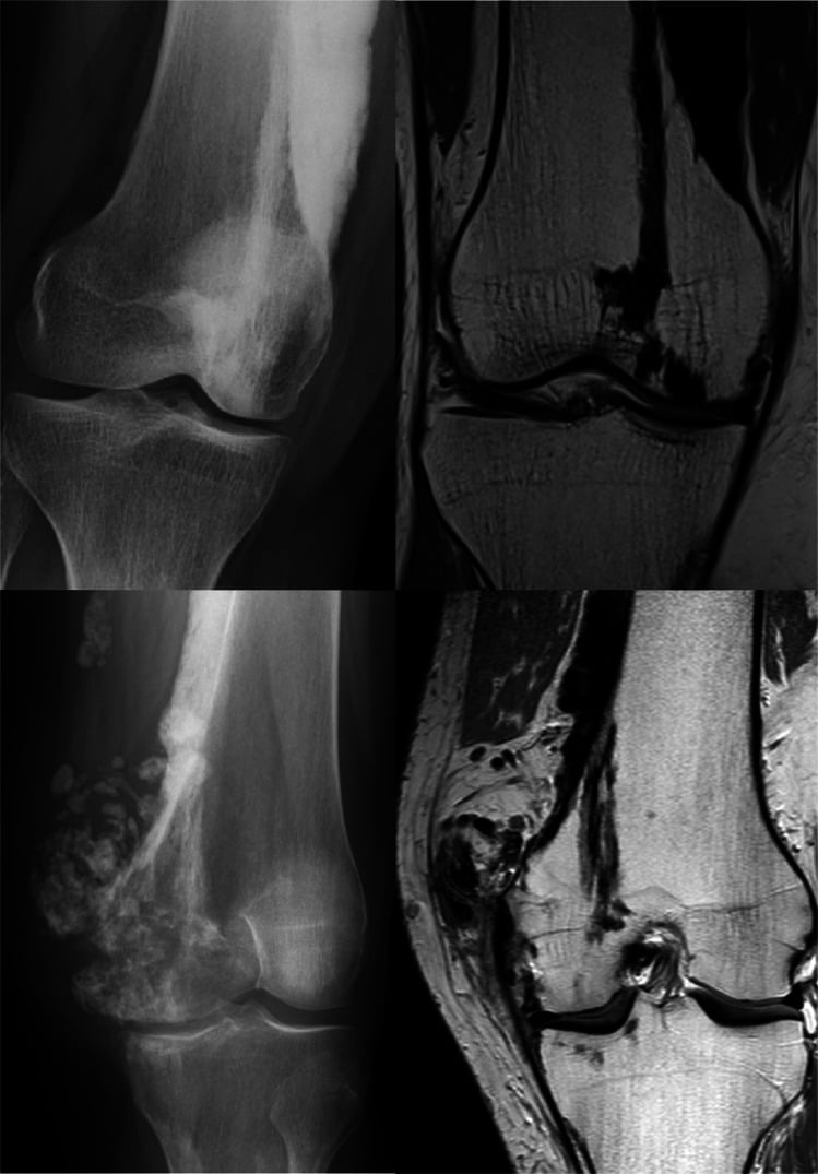 Knee radiographs and coronal MRI showing cortical, medullary and periarticular melorheostosis patterns