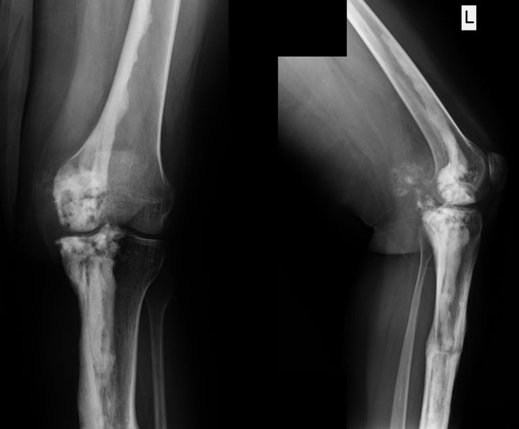 Three-year knee radiographs after deformity correction showing maintained alignment and persistent melorheostosis