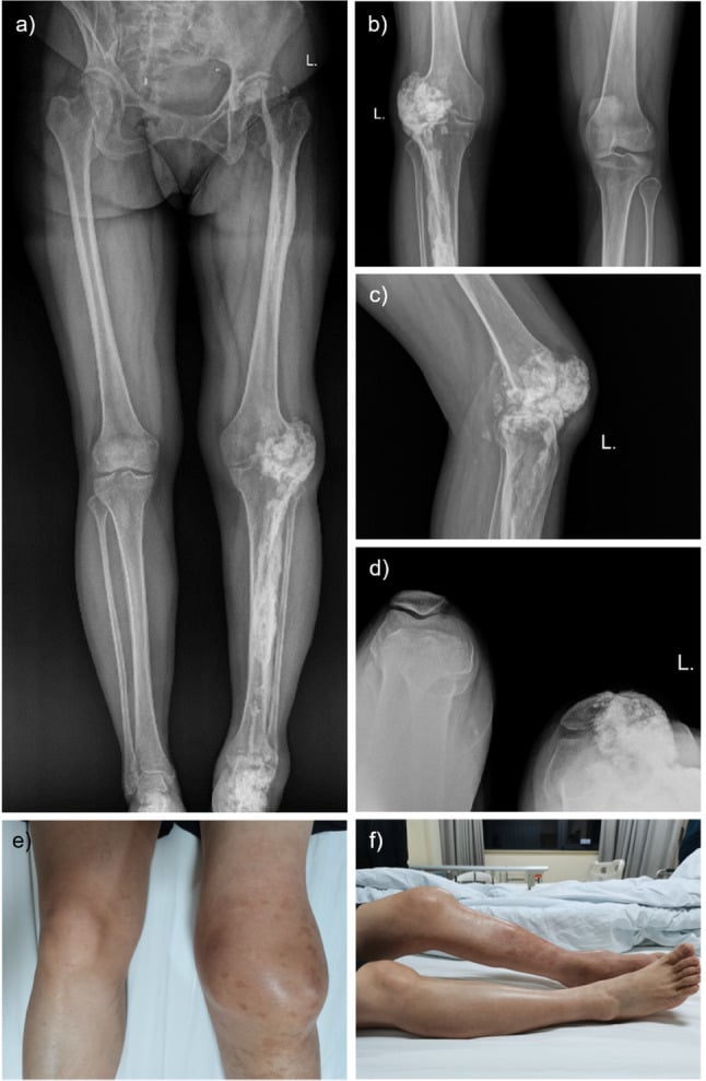 Full-length standing AP radiograph of lower extremity demonstrating continuous cortical hyperostosis