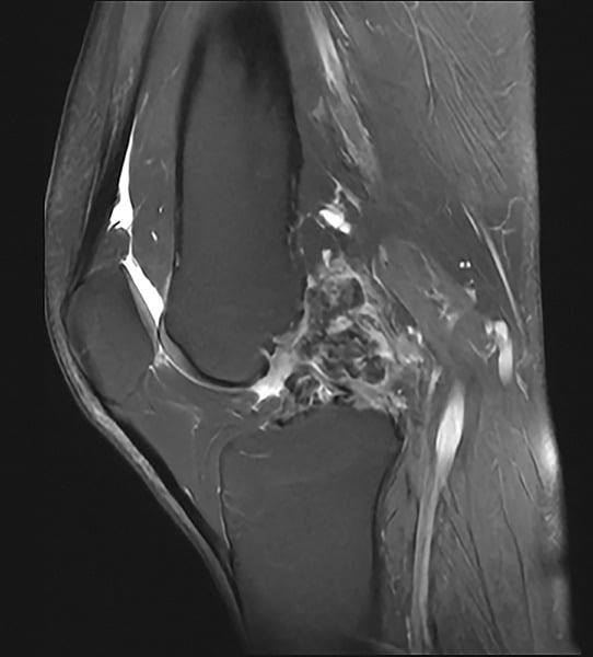 Proton density fat-saturated MRI of knee demonstrating dense cortical hyperostosis