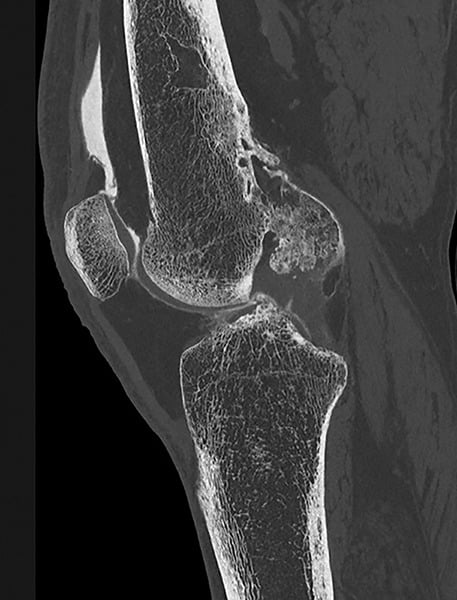 Axial CT arthrography of knee demonstrating dense cortical hyperostosis