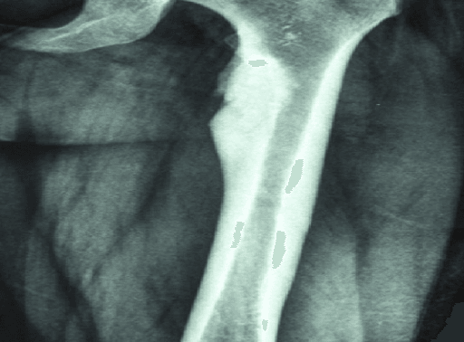 AP radiograph of the proximal femur in melorheostosis showing dense flowing cortical hyperostosis resembling dripping candle wax.