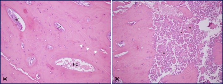 Paired histological sections, labelled (a) and (b), showing compact lamellar bone with Haversian canals in a melorheostotic radial lesion
