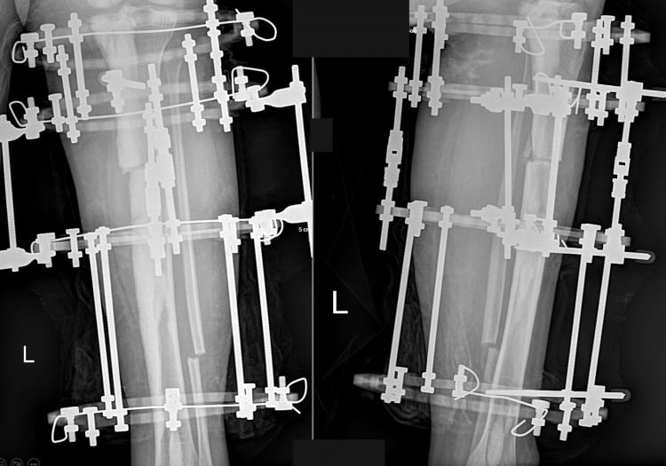 Postoperative tibial radiographs showing deformity correction with a circular external fixator