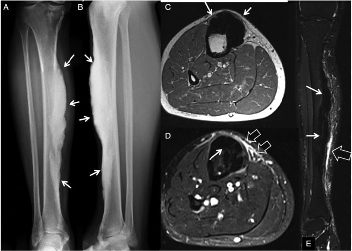 Tibial radiographs and MRI showing candle-wax hyperostosis with adjacent periosteal and soft-tissue change