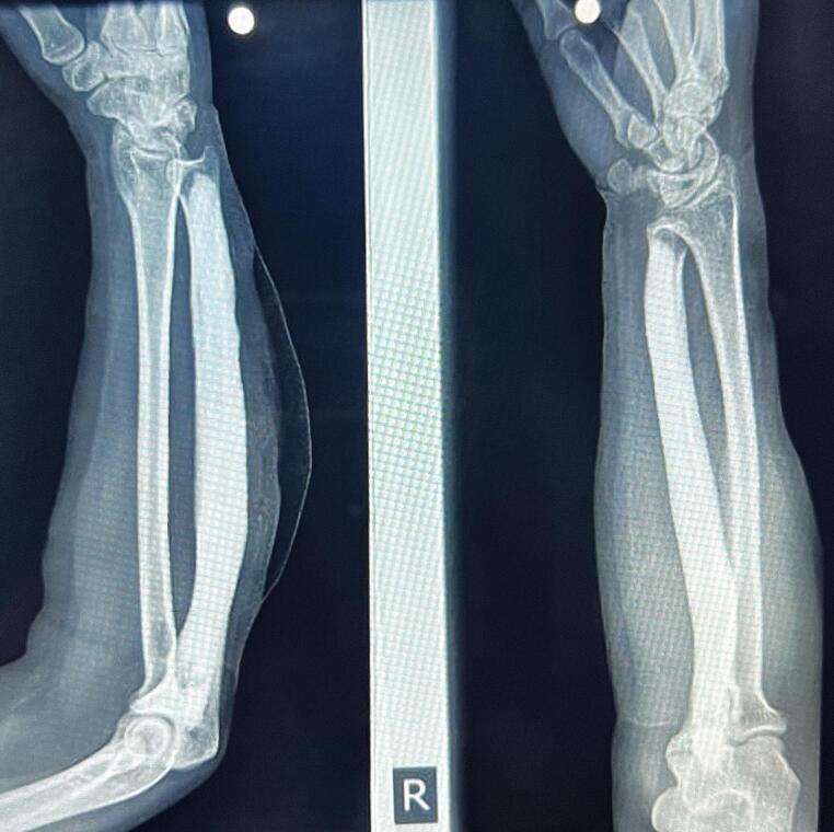 Post-osteoplasty forearm radiographs showing restored ulnar contour
