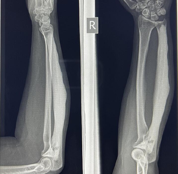 Anteroposterior and lateral forearm radiographs showing monostotic ulnar candle-wax hyperostosis and bowing