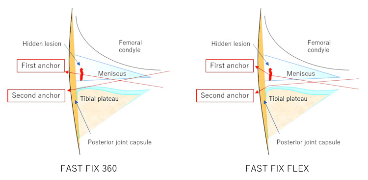 Two schematics labelled FAST FIX 360 and FAST FIX FLEX comparing first and second anchor trajectories for a hidden ramp lesion
