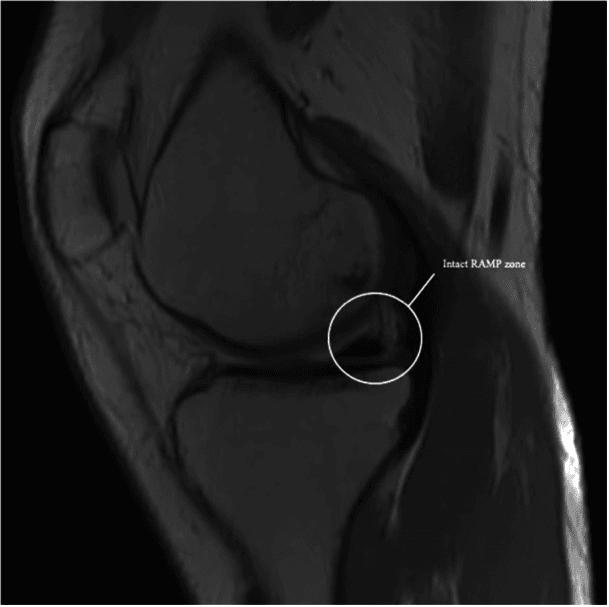 Sagittal knee MRI with a circle labelled intact RAMP zone at the posterior horn meniscocapsular junction