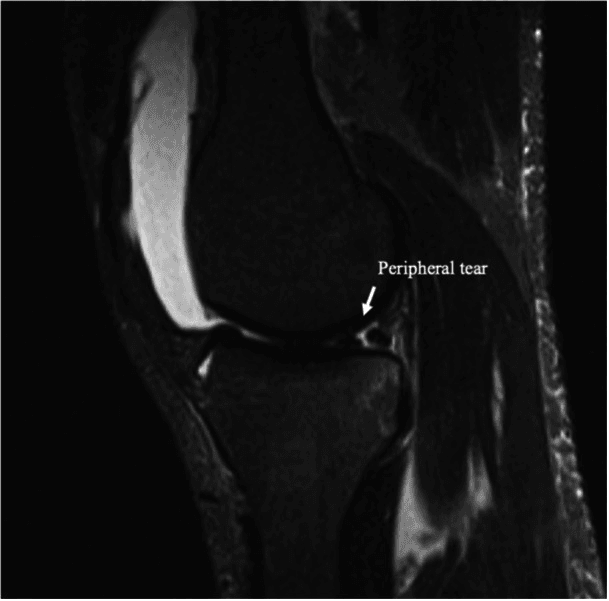 Sagittal fluid-sensitive knee MRI with an arrow labelled peripheral tear at the periphery of the posterior horn
