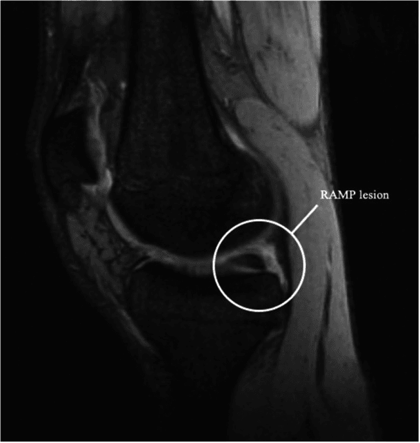 Sagittal knee MRI with a circle labelled RAMP lesion at the posterior horn meniscocapsular junction