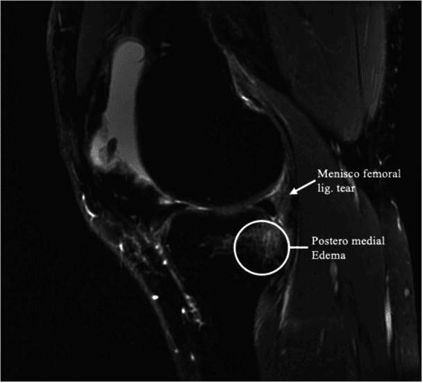 Sagittal fluid-sensitive knee MRI with circled posteromedial oedema in the posterior tibia and an arrow at a labelled meniscofemoral ligament tear