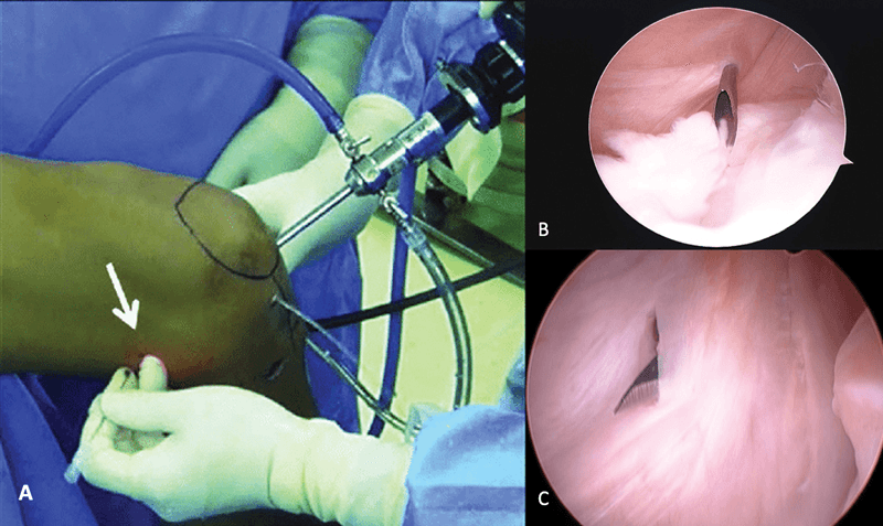 Three panels: external view of transillumination and needle localisation on the flexed knee (A), and two arthroscopic views of instruments entering the joint (B, C)
