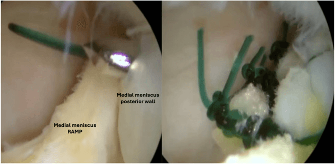 Two arthroscopic views: a suture hook carrying a green suture at structures labelled medial meniscus RAMP and medial meniscus posterior wall, then the repair after the sutures are tied