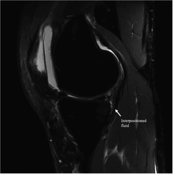 Sagittal fluid-sensitive knee MRI with an arrow labelled interpositioned fluid at the posterior margin of the tibia
