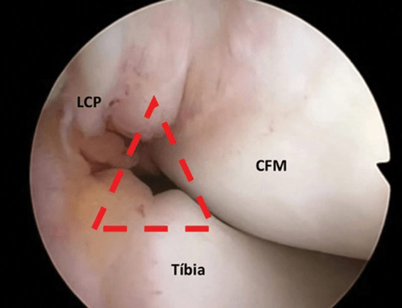 Arthroscopic trans-notch view with a red dashed triangle between structures labelled LCP (posterior cruciate ligament), CFM (medial femoral condyle) and tibia