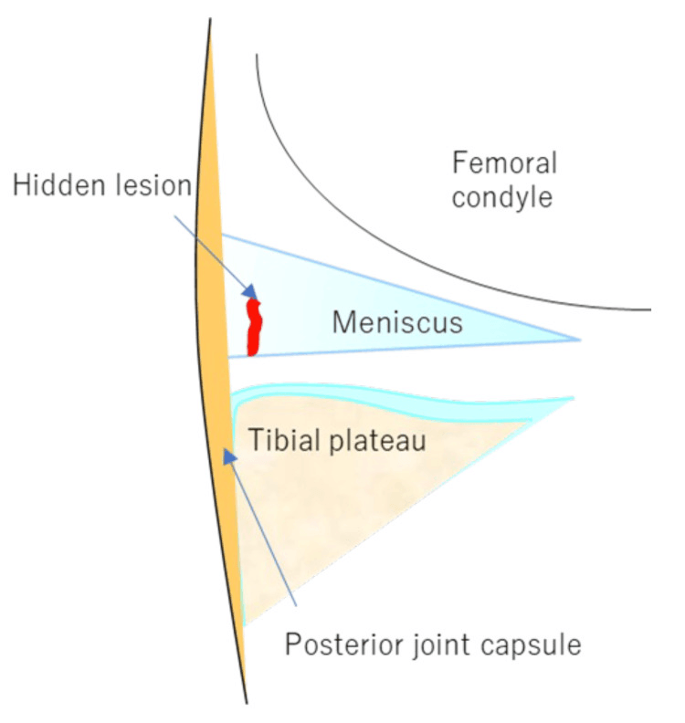 Cross-sectional schematic labelled femoral condyle, meniscus, tibial plateau and posterior joint capsule, with a hidden lesion marked in red at the periphery of the meniscus against the capsule