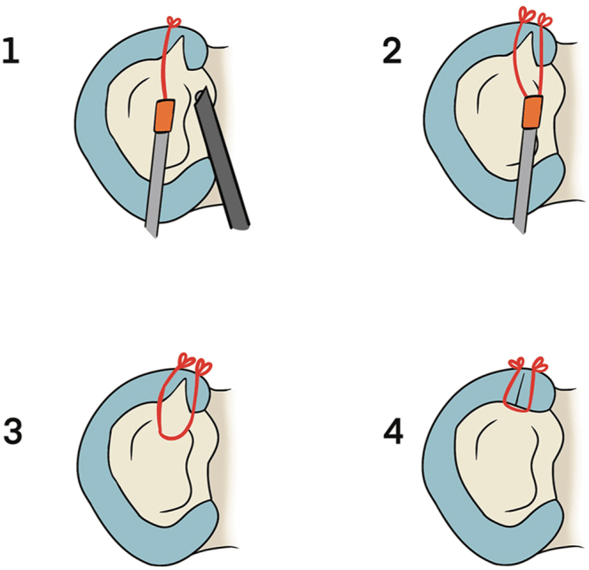 All-inside meniscal suturing sequence