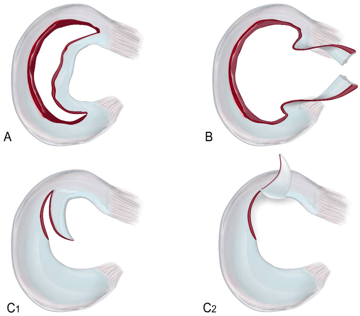 Diagrams of displaced meniscal tears: a bucket-handle fragment, displaced fragments and flap tears