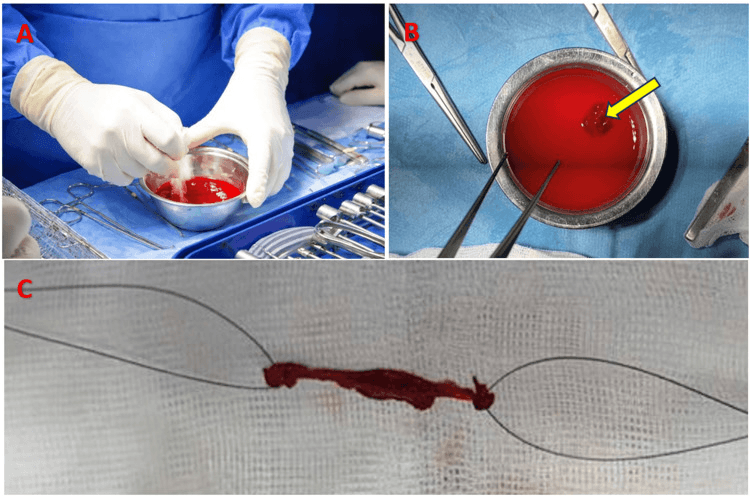 Preparation of a fibrin clot for meniscal repair augmentation