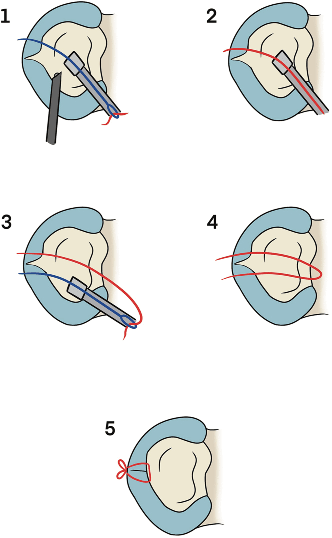 Inside-out meniscal suturing sequence