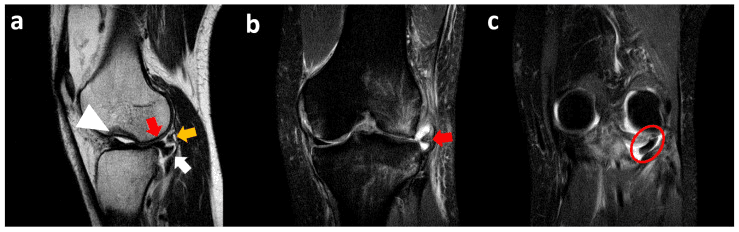MRI of lateral meniscal displacement into the popliteal hiatus
