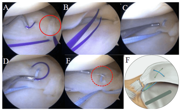Remodified Mason-Allen suture configuration for posterior-root repair