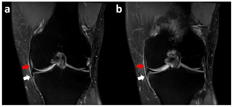 Coronal MRI of an inferiorly displaced medial meniscal flap