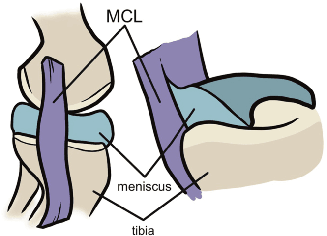 Labelled drawing of the medial meniscus and the medial collateral ligament