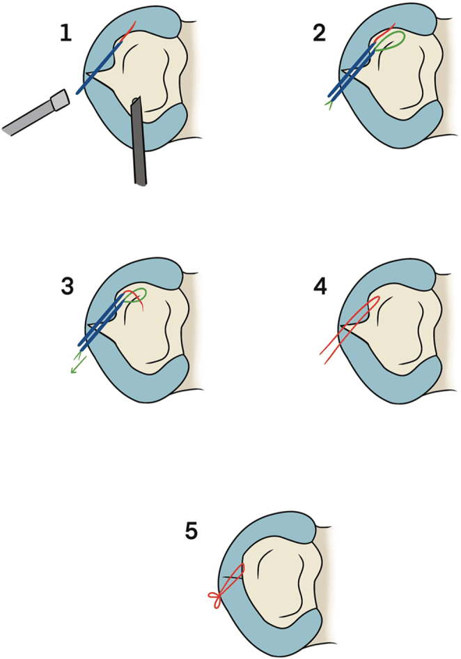 Outside-in meniscal suturing sequence