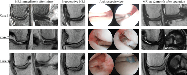 Serial MRI and arthroscopy before and after posterior-root repair