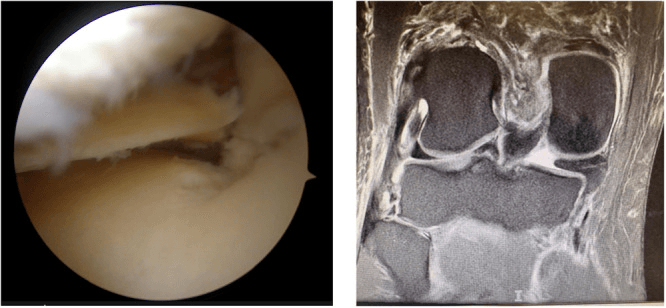 Medial meniscus posterior-root avulsion on arthroscopy and coronal MRI