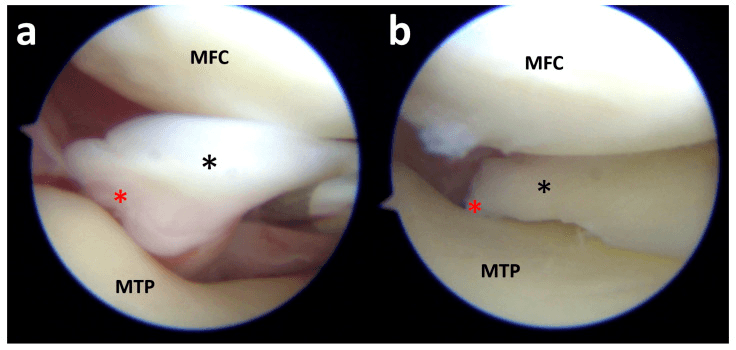 Arthroscopic posterior-root detachment and transosseous repair