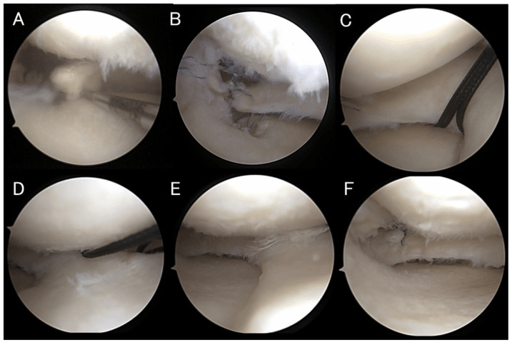 Arthroscopic posterior-root repair and meniscal centralisation sequence